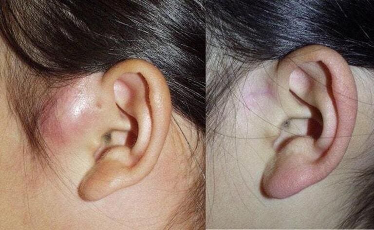 耳瘻孔・耳前瘻孔の写真