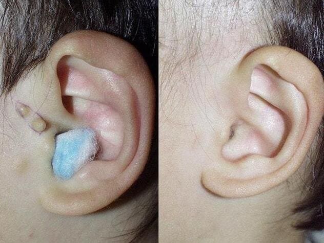 副耳の写真