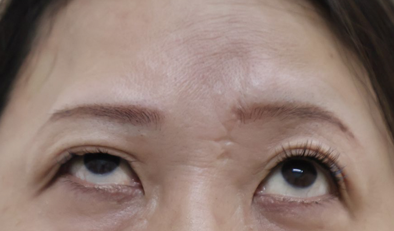 上方視 右眉の拳上ができない