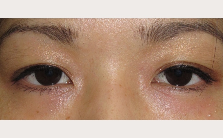目頭切開(V-Y法)+眼瞼下垂手術前