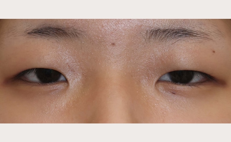 目頭切開(Z法)+眼瞼下垂手術前