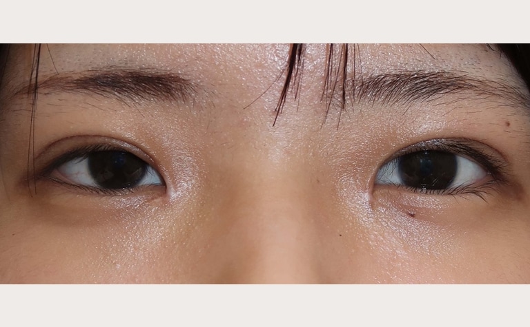 目頭切開(Z法)+眼瞼下垂手術前