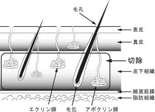 わきが