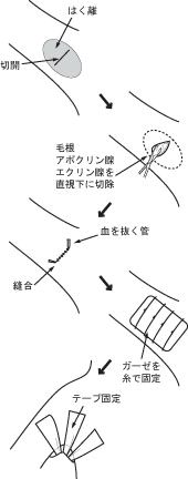 反転剪除法