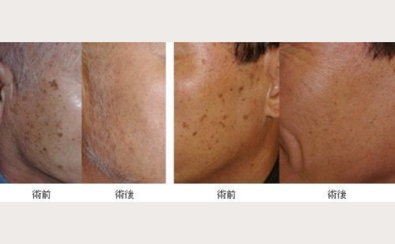 脂漏性角化症の施術前後