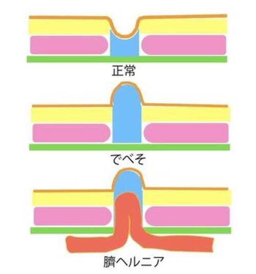 臍突出症（でべそ）の画像