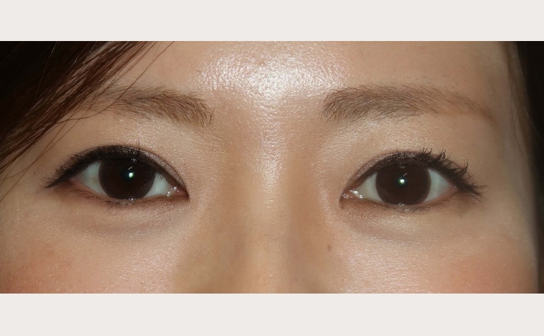 眼瞼下垂症の手術例