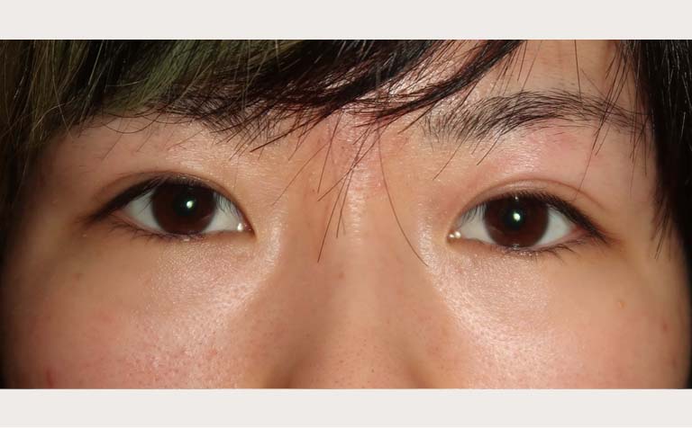 眼瞼下垂症の術後半年