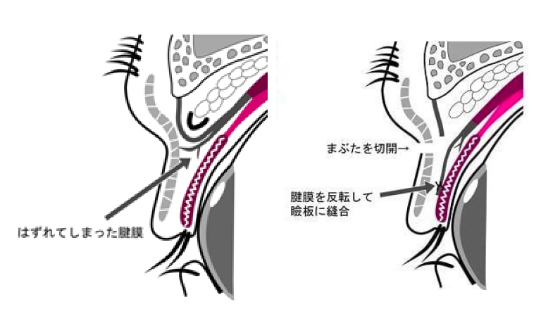 信州大学式の手術図