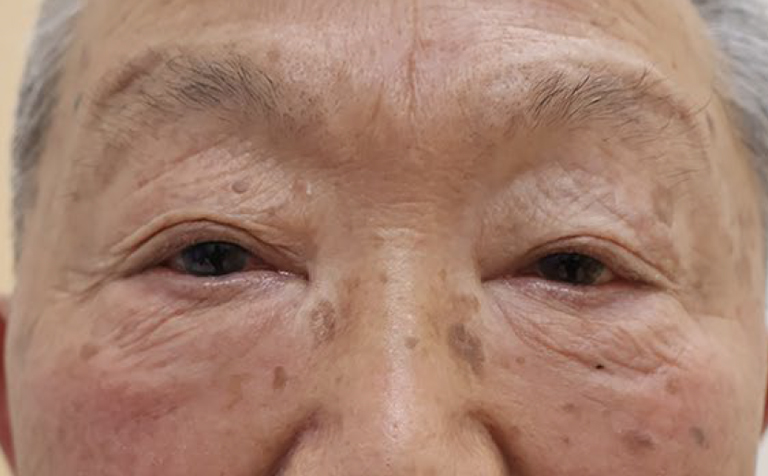 左右の形の調整 埋没法