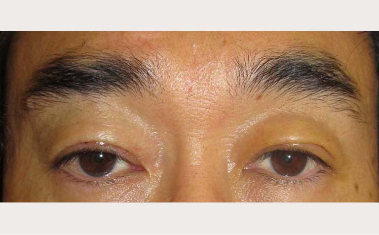 先天性眼瞼下垂症の手術例