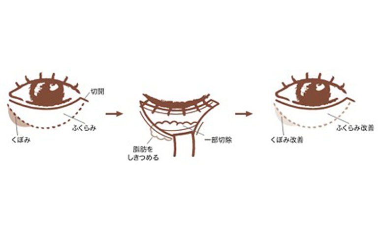 下眼瞼しわ取り術（ミッドフェイスリフト併用）