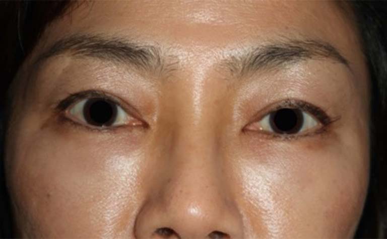 PRP術後下眼瞼