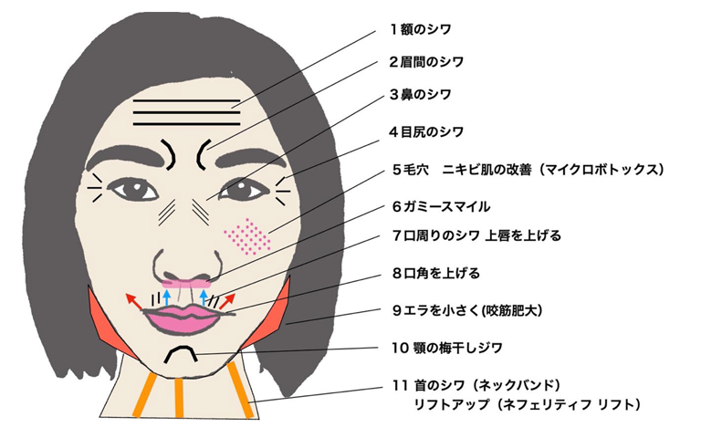 ボトックス治療
