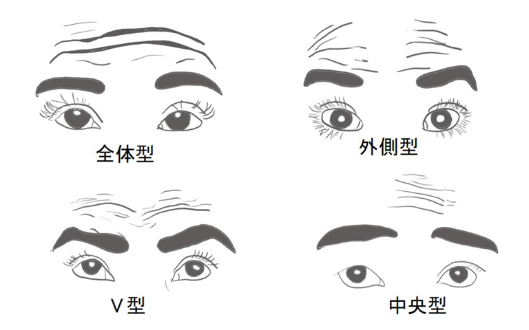 4型に分類