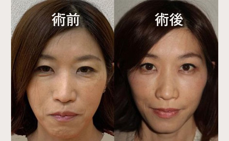 ヒアルロン酸・ボトックスの複合治療